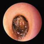 This is Cerumen in an Ear Canal
